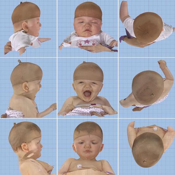 Kinderkrankenhaus Wilhemstift Schadelfehlbildungen Kinderkrankenhaus Wilhemstift Schadelfehlbildungen